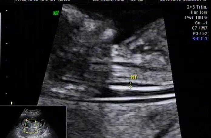 43岁重庆做试管供卵代生成功率 重庆大坪医院试管成功经验： ‘怀孕初期看孕